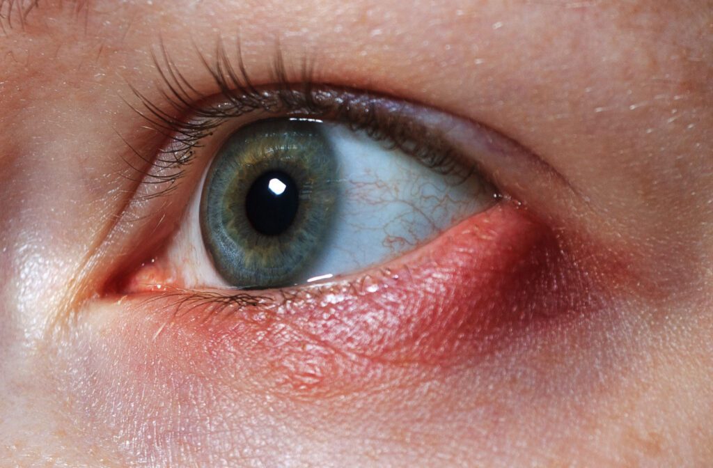 A close-up of an eye with a stye.
